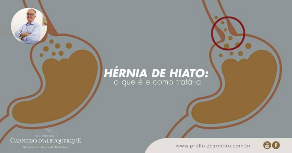 Ao fundo da imagem, há a representação da hérnia de hiato.