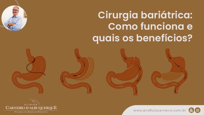Cirurgia Bariátrica: Como Funciona E Quais Os Benefícios? - Prof Dr ...