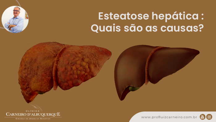 A imagem contém uma representação gráfica de um fígado com esteatose hepática e um fígado saudável.