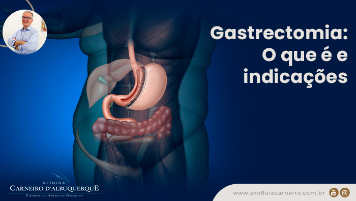 Gastrectomia: O Que é E Indicações - Prof Dr. Luiz Carneiro