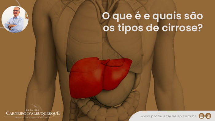 Ilustração médica mostrando o fígado em destaque, com o título O que é e quais são os tipos de cirrose e foto do Prof. Luiz Carneiro.