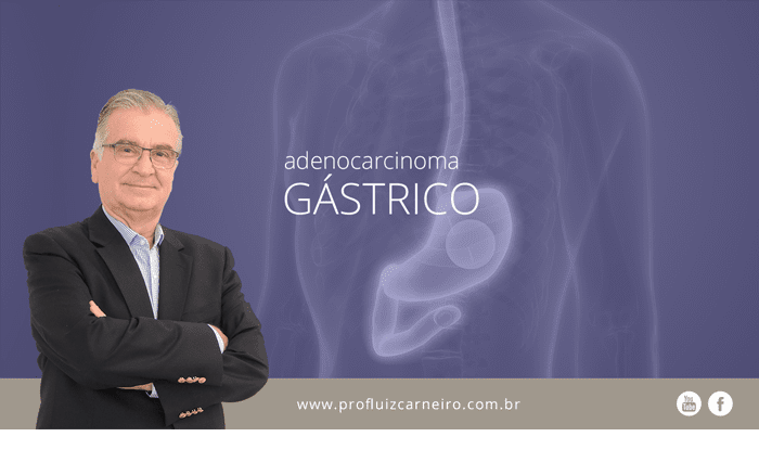 O que é adenocarcinoma gástrico - Por Prof. Dr. Luiz Carneiro