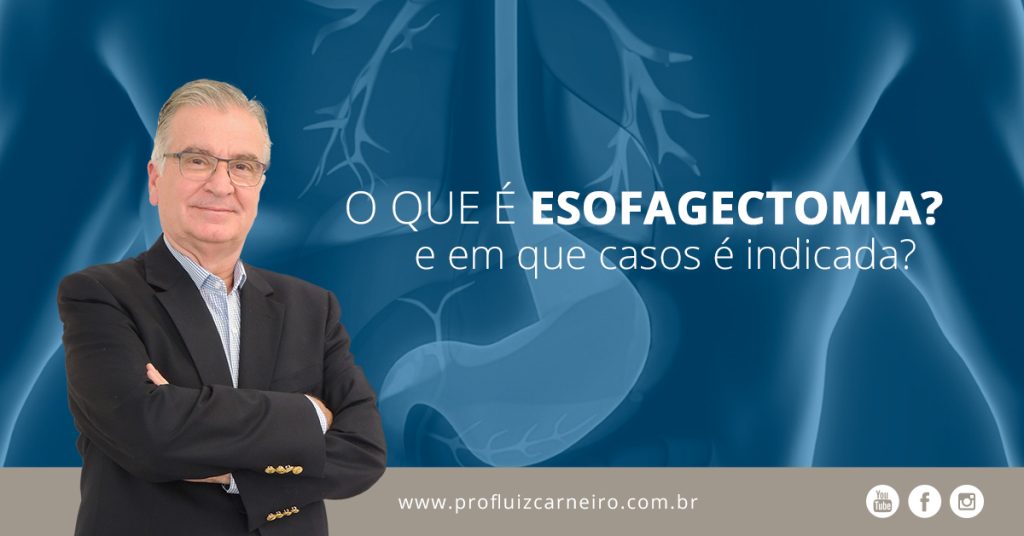 Esofagetcomia: o que é e casos indicados | Por Prof Luiz Carneiro CRM 22761 | Diretor do serviço de transplante e cirurgia do fígado do hospital das clínicas da faculdade de medicina da USP.
