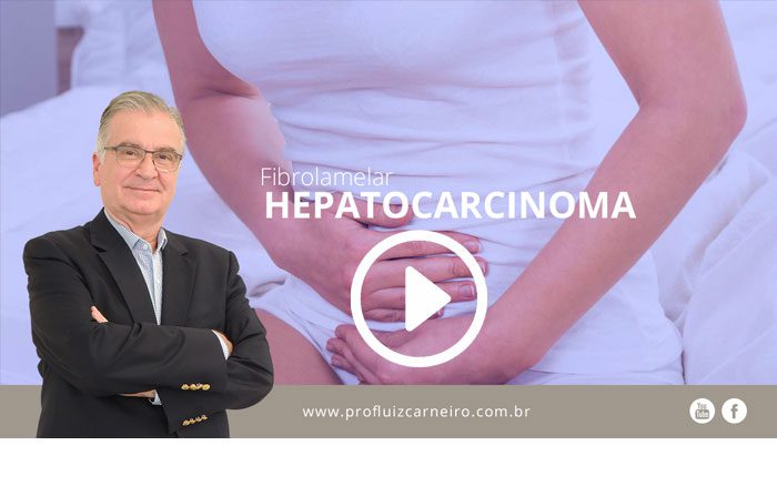 Hepatocarcinoma Fibrolamelar| Por Prof Luiz Carneiro CRM 22761 | Diretor do serviço de transplante e cirurgia do fígado do hospital das clínicas da faculdade de medicina da USP.