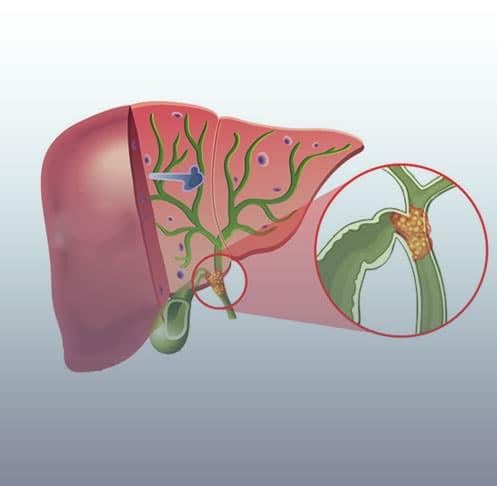 Ao fundo da imagem, há uma representação gráfica de um fígado com o tumor de klatskin nas vias biliares.