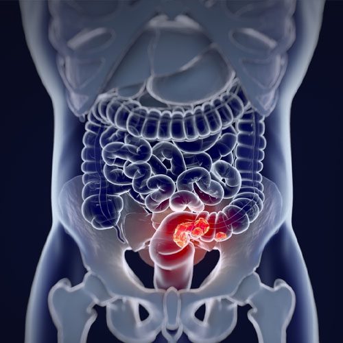 A imagem mostra uma ilustração do aparelho digestivo com um efeito para destacar o colorretal.