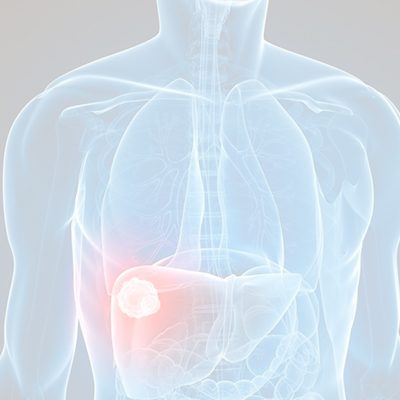 A imagem mostra uma ilustração dos órgãos do corpo humano com uma bolinha no fígado em destaque, representando o cisto.