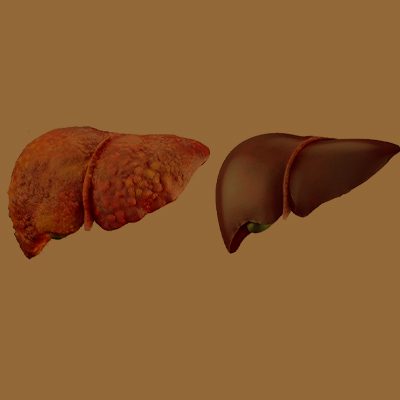 A imagem contém uma representação gráfica de um fígado com esteatose hepática e um fígado saudável.