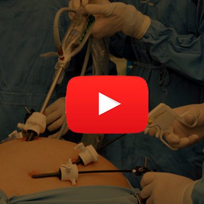 A imagem mostra uma barriga e alguns palitos de video laparoscopia fincados na barriga.