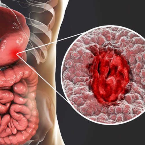 A imagem mostra uma ilustração do fígado, intestino e estômago de um humano. E há uma seta com zoom no estômago mostrando uma ferida machucada.