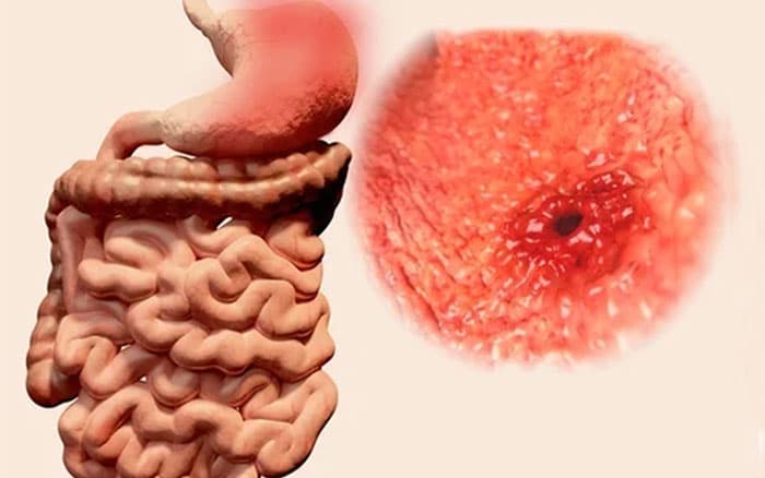 Ao fundo da imagem, há a representação da úlcera no esôfago.