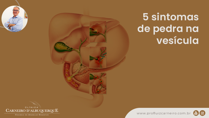 Ilustração médica mostrando a vesícula biliar e o trajeto das pedras, com o título 5 sintomas de pedra na vesícula e foto do Prof. Luiz Carneiro.
