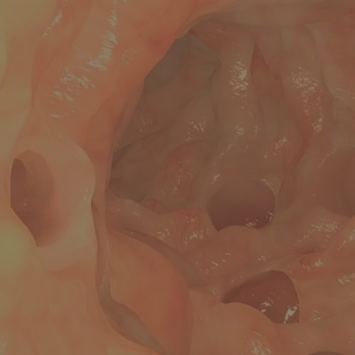 A imagem mostra uma ilustração digital do divertículo no trato gastrointestinal.
