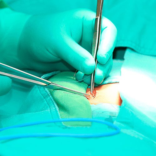 A imagem mostra a ilustração de um procedimento cirúrgico.
