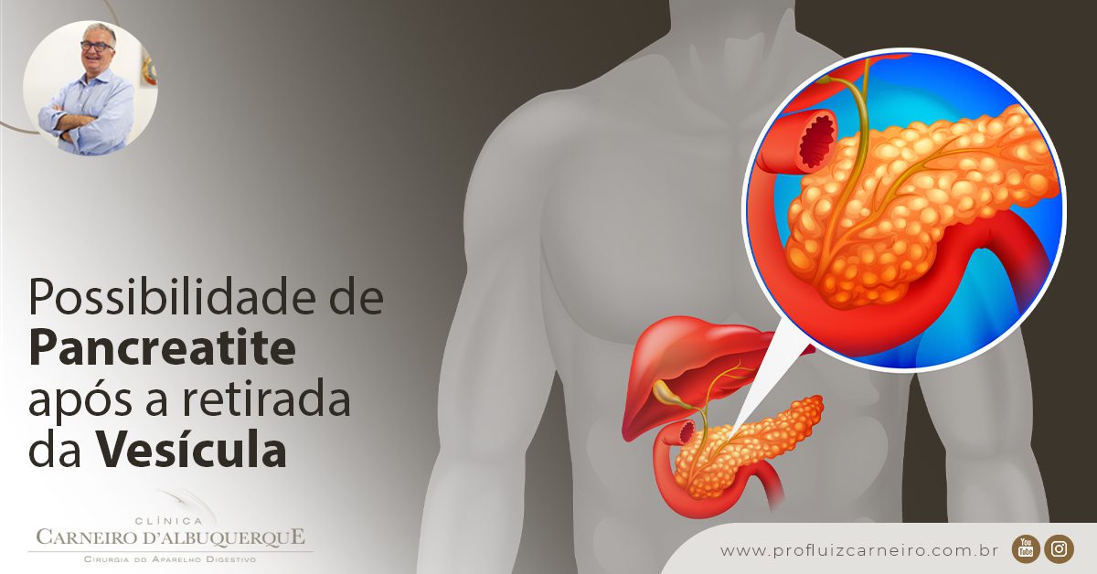 Possibilidade De Pancreatite Ap S A Retirada Da Ves Cula Prof Dr