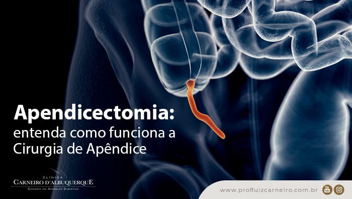 apendicectomia entenda como funciona a cirurgia de apendice prof dr luiz carneiro bg Prof Dr. Luiz Carneiro
