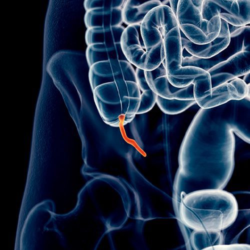 A imagem mostra a ilustração de uma situação de apendicite.