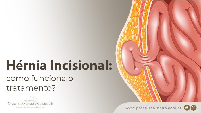 hernia incisional como funciona o tratamento prof dr luiz carneiro bg Prof Dr. Luiz Carneiro
