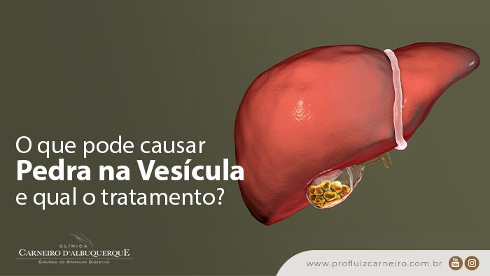 o que pode causar pedra na vesicula e qual o tratamento prof dr luiz carneiro bg Prof Dr. Luiz Carneiro