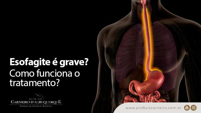 esofagite e grave como funciona o tratamento strongnbspnbsp strong prof dr luiz carneiro bg Prof Dr. Luiz Carneiro