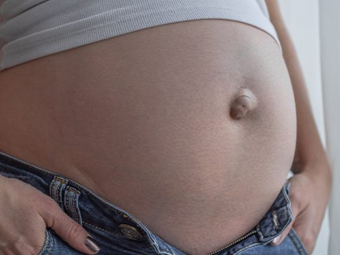 a imagem ilustra uma pessoa grávida com uma hérnia umbilical