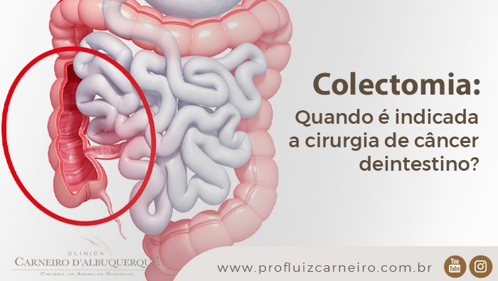 colectomia quando e indicada a cirurgia de cancer de intestino prof dr luiz carneiro bg Prof Dr. Luiz Carneiro