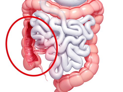 a imagem ilustra um sistema digestivo, enquanto um círculo dá destaque para parte do cólon e apêndice, presentes no intestino grosso