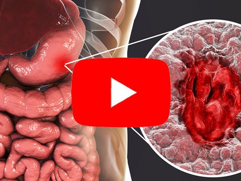 a imagem ilustra um sistema digestivo, dando zoom estômago e mostrando uma úlcera