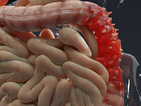 A imagem mostra o intestino delgado e o intestino grosso de um humano com uma grande área vermelha e inflamada no centro do intestino grosso.