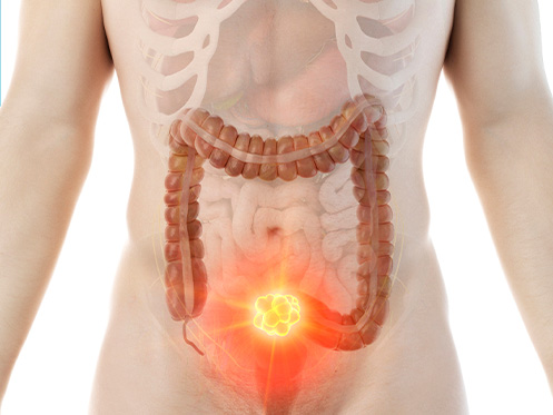 A imagem mostra um corpo humano com um grande tumor no final do intestino grosso. O tumor está destacado em vermelho e parece ser bastante grande.