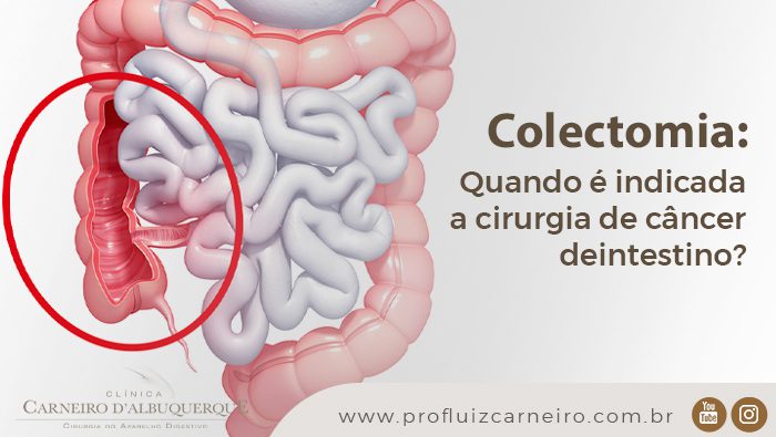 colectomia quando e indicada a cirurgia de cancer de intestino prof dr luiz carneiro bg