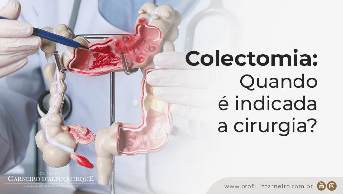 colectomia-quando-e-indicada-a-cirurgia-prof-dr-luiz-carneiro-bg