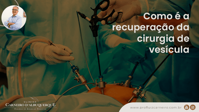 como e a recuperacao da cirurgia de vesicula prof dr luiz carneiro bg