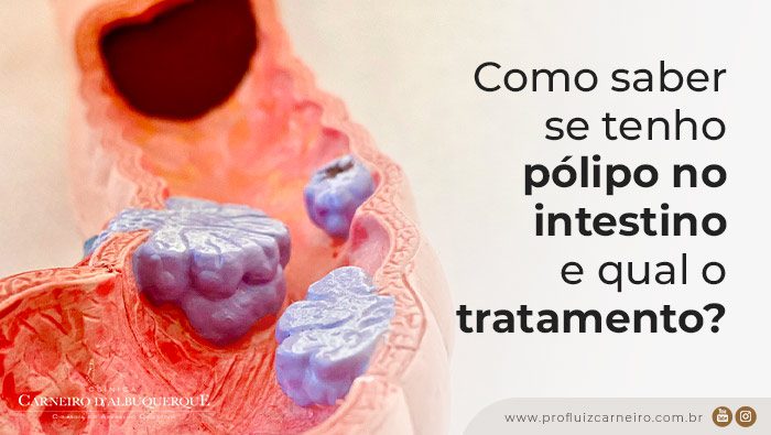 a imagem ilustra um modelo anatômico de pólipos no colon