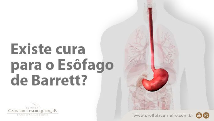 existe cura para o esofago de barrett prof dr luiz carneiro bg