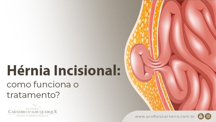 hernia incisional como funciona o tratamento prof dr luiz carneiro bg