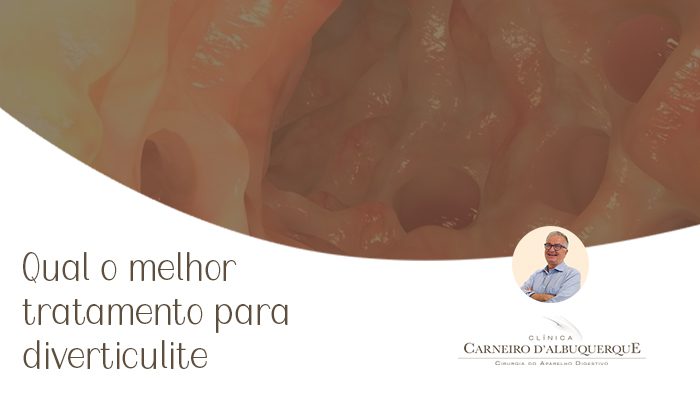 A imagem mostra uma ilustração digital do divertículo no trato gastrointestinal.