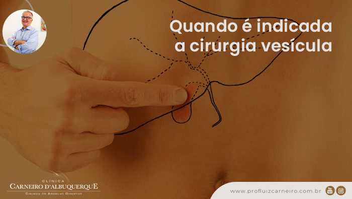 A imagem mostra uma barriga com um desenho de fígado e uma mão apontando para a vesícula dentro do fígado.