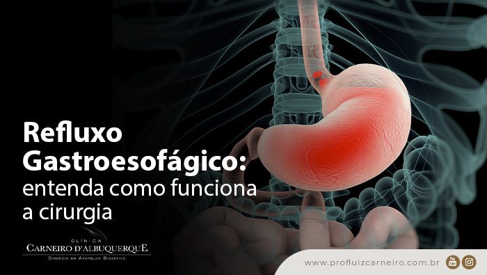 refluxo gastroesofagico entenda como funciona a cirurgia prof carneiro bg