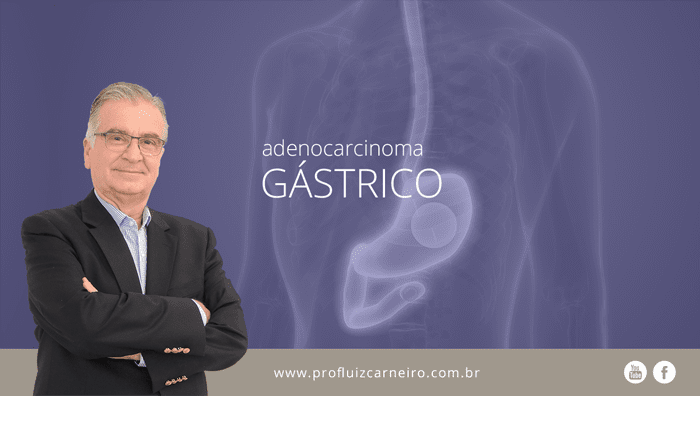 Destacada O que e adenocarcinoma gastrico Por Prof Dr Luiz Carneiro