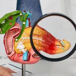 A imagem ilustra uma estrutura em 3D do pâncreas, onde há uma lupa na frente da região, destacando uma inflamação no pâncreas.