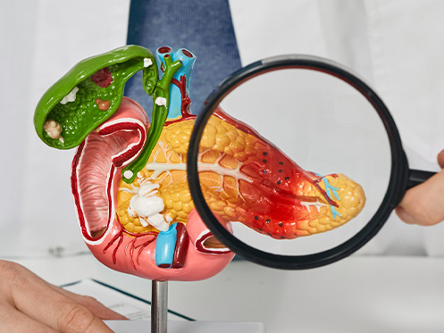 A imagem ilustra uma estrutura em 3D do pâncreas, onde há uma lupa na frente da região, destacando uma inflamação no pâncreas.