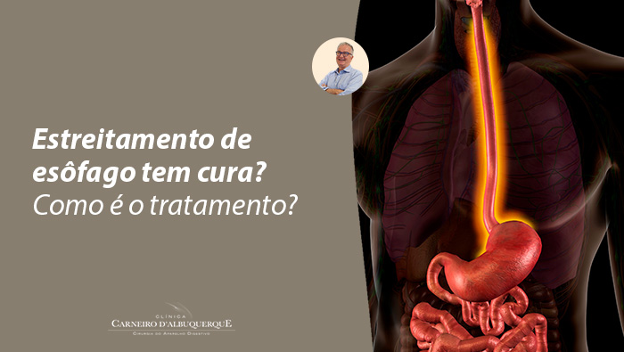 Ilustração do sistema digestivo humano, destacando o esôfago e o estômago em tons iluminados, representando refluxo gastroesofágico ou inflamação.