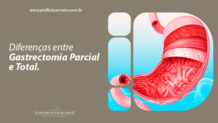 Ilustração médica do estômago humano, destacando suas camadas internas e conexões com o esôfago e intestino delgado.