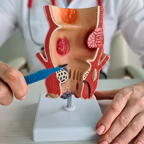 Médico segurando pinça e apontando para um modelo anatômico do reto com hemorroidas, ilustrando estruturas internas e externas.