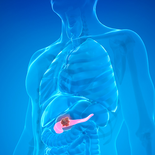 Ilustração do corpo humano destacando o pâncreas com uma área escura, indicando possível tumor na região pancreática.
