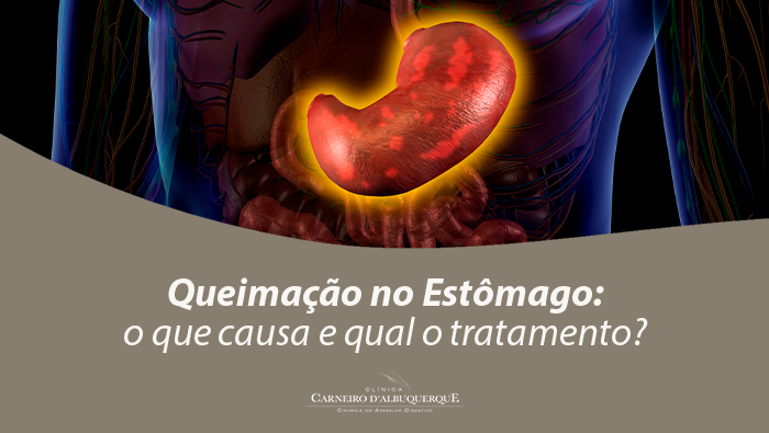Queimação No Estômago: O Que Causa E Qual O Tratamento? - Prof Dr. Luiz ...