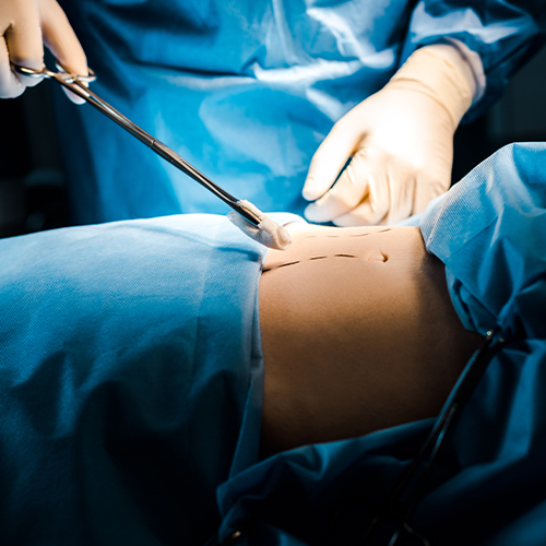 Procedimento cirúrgico abdominal com equipe médica manipulando instrumentos em campo estéril durante operação.
