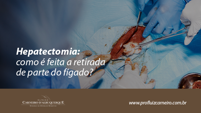 Equipe médica realizando procedimento cirúrgico com exposição do fígado, representando hepatectomia e tratamento cirúrgico de doenças hepáticas.