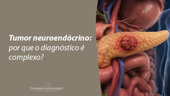 Ilustração anatômica do pâncreas com tumor neuroendócrino em destaque, representando alterações pancreáticas e diagnóstico médico.